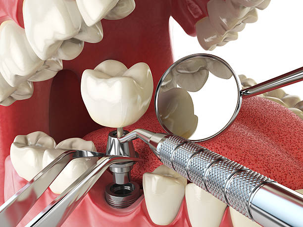 Best Emergency Treatment for Dental Infections or Abscesses in Clovis, CA